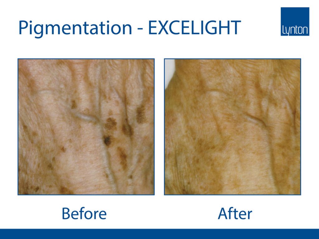 Best pigmentation removal