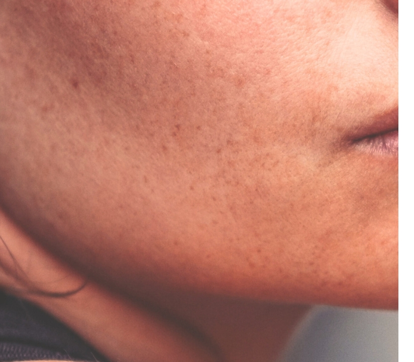 sagging skin treatmentss
