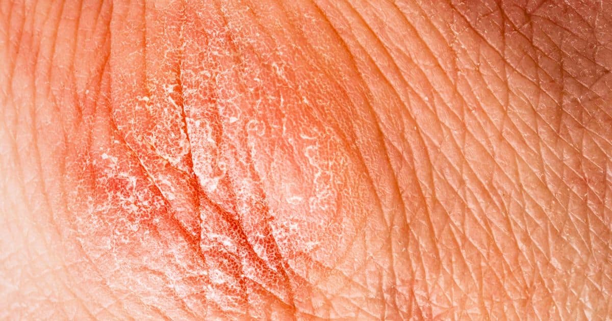 led therapy for eczema